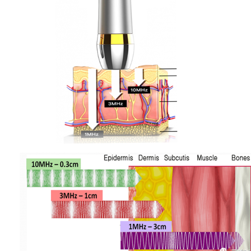 El instrumento de belleza ultrasónico de 10 MHz desarrollado por la empresa.